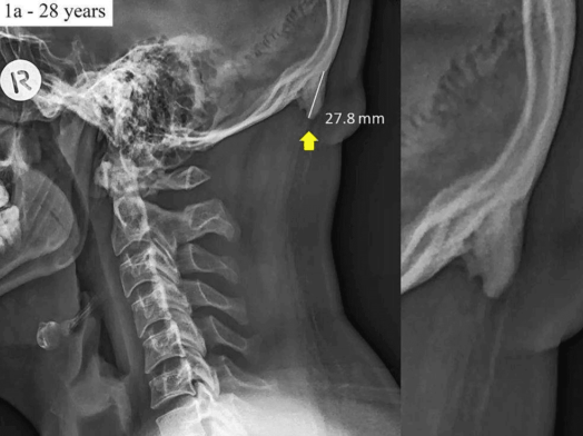 Evolution at Work? New Bone Growth From Excessive Smartphone Use